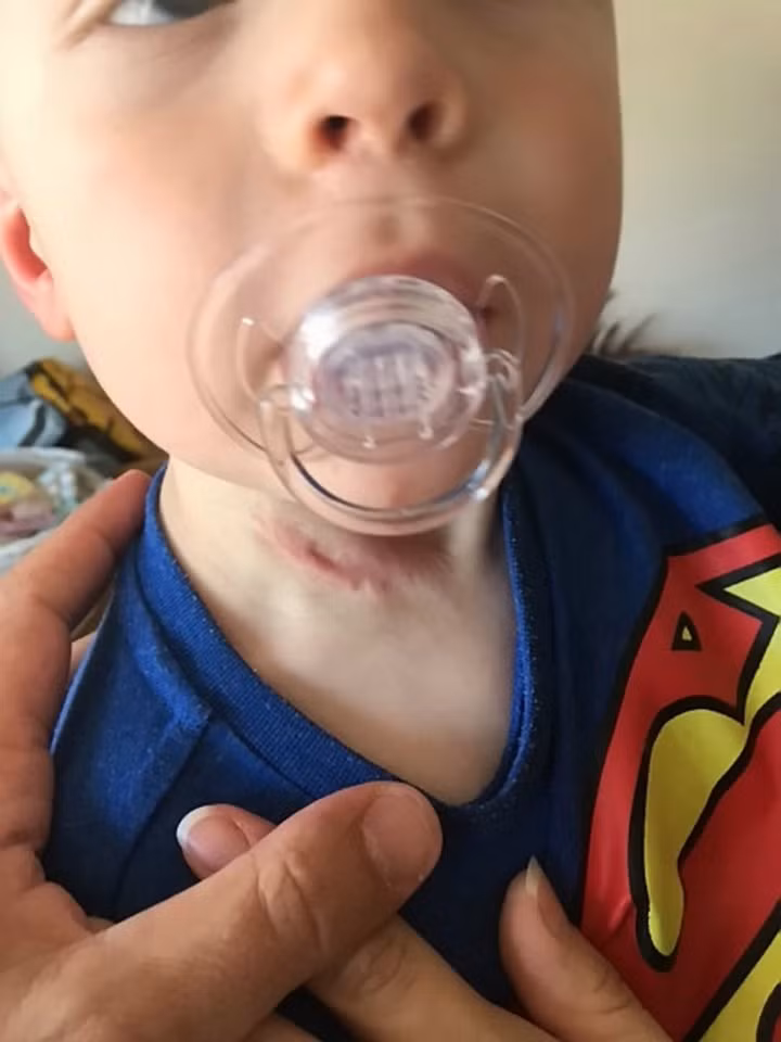 Ngay sau khi tình hình vừa mới trở nên sáng sủa hơn một chút thì Charlie bỗng bị suy thận và viêm một bên phổi khiến bé bị hôn mê trong suốt 12 ngày và trong suốt thời gian đó, bé phải truyền nước khiến cơ thể to phình gần gấp đôi. 