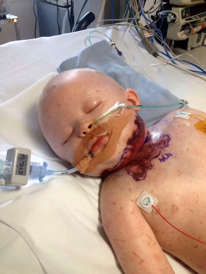 Charlie Cave mới chỉ 15 tháng tuổi khi căn bệnh rất nhiều trẻ em mắc phải bỗng biến chứng thành viêm cân mạc hoại tử và đe dọa tính mạng của bé dẫn đến hôn mê và khó biết sống chết ra sao trong suốt 2 tuần. 