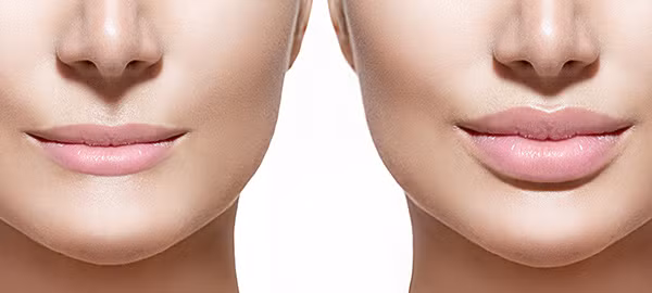 Phương pháp bơm môi bằng chất làm đầy cho một đôi môi căng mọng một cách tự nhiên cũng đang được rất nhiều phụ nữ tìm đến. Chất gel này sẽ lấp đầy vào những phần môi đã bị xẹp do tuổi tác để làm mờ các nếp nhăn nhỏ. 