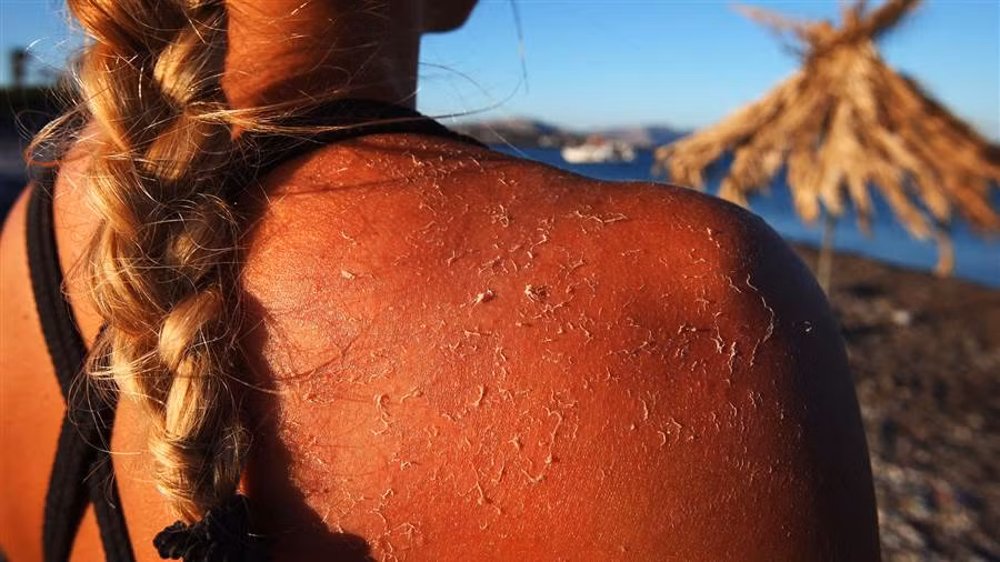 Khi da bị cháy nắng, làm mát vùng da bị cháy bằng nước hoặc sữa. Nếu bị ngộ độc nắng thì cần dùng các loại kem có thành phần cortisone. Để tránh bị cháy nắng cần dùng kem chống nắng có chỉ sổ SPF tối thiểu 30 và bôi lại sau mỗi 2-3 giờ. Lưu ý cần dùng đủ lượng để đạt hiệu quả bảo vệ. 