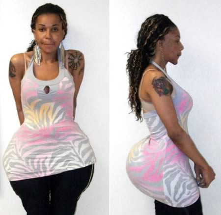 “Bác sĩ” Oneal Morris đã tìm ra cách làm đẹp vòng 3 cho phụ nữ theo đúng nghĩa đen là bơm một hỗn hợp gồm xi măng, siêu keo, dầu khoáng và một chất dùng để vá lốp xe. Một bệnh nhân đã tìm đến bác sĩ lang băm này để rồi được rạch vòng 3 và bơm hỗn hợp điên rồ này vào sau đó dán vết thương lại bằng keo dán. Bác sĩ này sau đó đã bị cảnh sát bắt vì hành nghề phẫu thuật thẩm mỹ không giấy phép. 