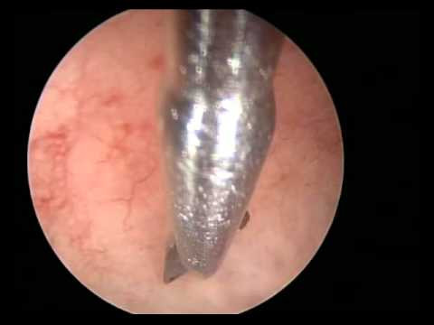 Giả thuyết về sự thành công của phương pháp mới này là khi thành tử cung bị cào xước, cơ thể lập tức có phản ứng “sửa chữa” bằng cách sản sinh ra những thành phần tăng trưởng cũng như tế bào gốc trong tử cung, nhờ vậy phôi thai có thể bám dính và phát triển. Một vài nghiên cứu khác cho rằng chính việc cào xước thành tử cung đã kích hoạt những gien giúp phôi thai bám dính. Phương pháp mới này có tỉ lệ thành công khá cao mặc dù vẫn đang trong quá trình thử nghiệm. 