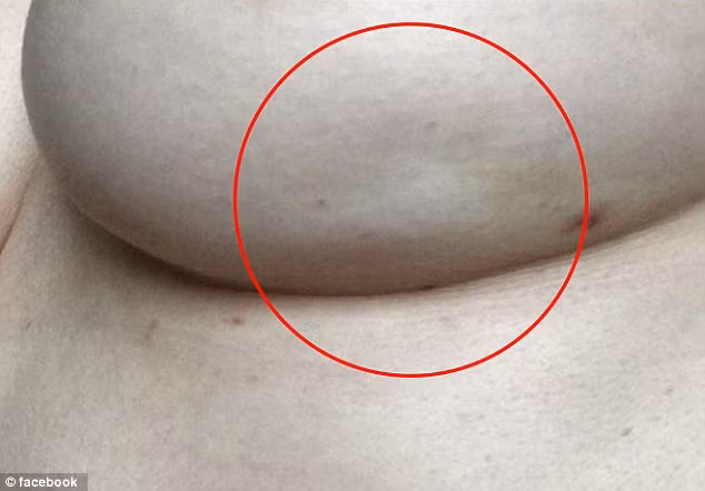 Người phụ nữ này đã đưa hẳn một tấm ảnh chụp bên ngực trái của mình lên mạng để chỉ rõ phần lõm bất thường trên ngực mình đồng thời đưa ra lời cảnh báo phụ nữ nên cẩn trọng với dấu hiệu lạ nhưng lại rất dễ bị bỏ qua này để phát hiện sớm bệnh ung thư vú. 