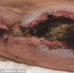 Canxi phòng vệ là một bệnh hiếm gặp trong đó canxi tích tụ và làm nghẽn mạch máu khiến máu không lưu thông để nuôi dưỡng được phần da. Thống kê cứ 600 bệnh nhân chạy thận mới có một trường hợp bị canxi phòng vệ khiến da nổi đỏ, lở loét và đau đớn. 