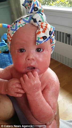 Một bé gái đau đớn vì cứ 4 tiếng là da bong tróc một lần được coi là một trong số ít người trên thế giới và cũng là người trẻ nhất mắc bệnh Harlequin Ichthyosis, hay còn gọi là bệnh vảy cá. Tình trạng do gien này khiến da của bé Harper Foy mọc nhanh gấp 10 lần người bình thường. Các bác sĩ cho rằng bé sẽ không sống được nhưng đến nay Harper đã tròn 1 tuổi. Tuy nhiên, da bé luôn cần được “tưới nước” thì mới sống được. 