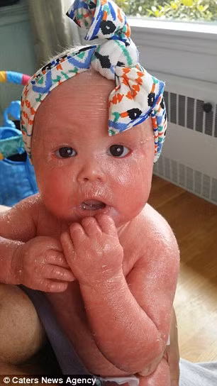 Một bé gái đau đớn vì cứ 4 tiếng là da bong tróc một lần được coi là một trong số ít người trên thế giới và cũng là người trẻ nhất mắc bệnh Harlequin Ichthyosis, hay còn gọi là bệnh vảy cá. Tình trạng do gien này khiến da của bé Harper Foy mọc nhanh gấp 10 lần người bình thường. Các bác sĩ cho rằng bé sẽ không sống được nhưng đến nay Harper đã tròn 1 tuổi. Tuy nhiên, da bé luôn cần được “tưới nước” thì mới sống được. 