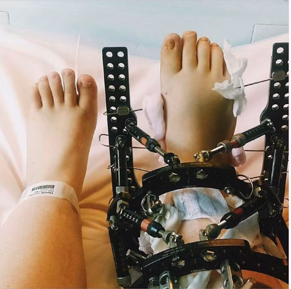 Năm 14 tuổi thì Llinos ngừng phát triển chiều cao và chỉ cao 1,3m. Vì muốn được cao hơn nên cô gái dũng cảm này đã quyết định phẫu thuật. Lần phẫu thuật đầu tiên là vào năm 2011 tại bệnh viện chỉnh hình Agnes Hunt. Phần xương đùi và xương cẳng chân của cô bị bẻ gãy rồi cố định vào khung thép bằng ốc vít. Lúc này xương đùi của cô mới chỉ dài 23cm. 