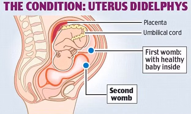 Cô gái này cho biết tuy có hai tử cung nhưng mỗi tử cung chỉ có một ống dẫn trứng nên “kỳ đèn đỏ” chỉ xảy ra mỗi tháng một lần như người bình thường. Tuy được các bác sĩ khuyến cáo chỉ nên dùng 2 băng vệ sinh dạng que cùng lúc trong những ngày ấy nhưng cô chỉ dùng có một.