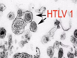Virus HTLV gây u lympho ở tế bào T: Là loại virus bị nhiễm khi tiếp xúc với các tế bào sinh học hoặc tế bào bị nhiễm virus như khi cho con bú, dùng chung kim tiêm hoặc xy lanh và cả quan hệ tình dục không an toàn. 