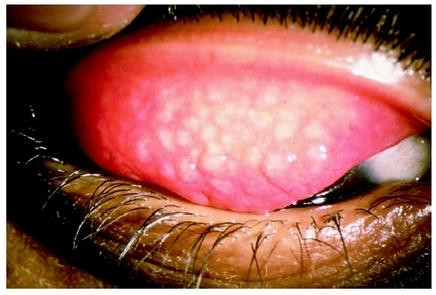 Đeo kính áp tròng có thể bị đau mắt hột, đây là nguyên nhân hàng đầu dẫn đến mù lòa trong khi hoàn toàn có thể phòng ngừa được. Đau mắt hột là do nhiễm nấm Chlamydia ở giác mạc và mí mắt, nguyên nhân thường là do vệ sinh kém. 