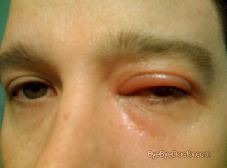 Viêm mí mắt là khi mí mắt bị viêm do vi khuẩn hoặc do trứng cá đỏ, mí mắt có thê ngứa, đỏ hoặc đóng vẩy khiến mắt bị mờ. 