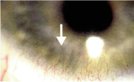Giảm oxy huyết là tác dụng phụ thường gặp khi đeo kính áp tròng trong thời gian dài do oxy cung cấp cho giác mạc bị thiếu. Hơn nữa giác mạc lấy oxy từ nước mắt, trong khi kính áp tròng lại làm mắt bị khô nên lượng oxy còn bị giảm nhiều hơn. 