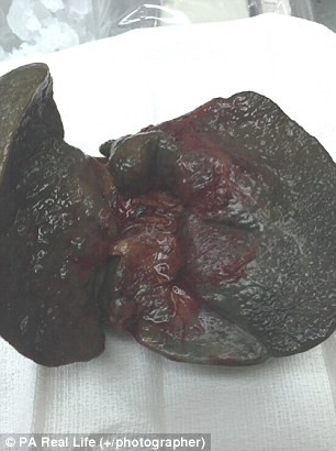 Lá gan của bé Allie Driva chuyển thành màu đen và cứng lại giống như một tảng than đá khi được cắt bỏ khỏi cơ thể bé xíu của bé vào tháng 7 năm ngoái. Cô bé đã gần chết khi bị teo đường mật khi đường mật bị viêm và tắc lại gây suy gan. 