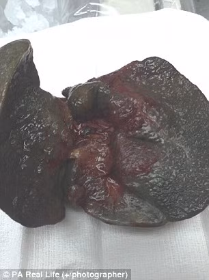 Lá gan của bé Allie Driva chuyển thành màu đen và cứng lại giống như một tảng than đá khi được cắt bỏ khỏi cơ thể bé xíu của bé vào tháng 7 năm ngoái. Cô bé đã gần chết khi bị teo đường mật khi đường mật bị viêm và tắc lại gây suy gan. 