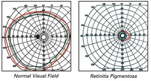Viêm võng mạc sắc tố là một nhóm bệnh di truyền khiến thị lực giảm dần. Nước ép cần uống gồm có mùi tây, tỏi tây, cà rốt, củ cải đỏ, bắp cải, tỏi, gừng, nho, chanh, mâm xôi, cần tây, cỏ mạch, táo và cải bó xôi. 