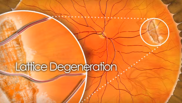 Thoái hóa tinh tể là tình trạng lớp võng mạc biên mỏng dần đi ảnh hưởng đến hình ảnh vùng biên. Hãy dùng nước ép mùi tây lẫn với cà rốt, táo, tỏi tây, cải bó xôi, gừng, củ cải đỏ, cải bắp, nho, cần tây, chanh, mâm xôi và cỏ mạch. 