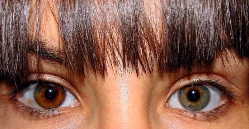 Phương pháp phẫu thuật cấy tròng mắt là đặt một lớp tròng mắt giả lên trên tròng mắt thật để thay đổi màu mắt. Cả quy trình tưởng như phức tạp này chỉ mất khoảng nửa tiếng để thực hiện.