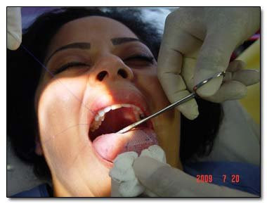 Phẫu thuật vá lưỡi là phương pháp khâu một miếng đệm lên trên lưỡi. Phương pháp này chỉ dành cho những người muốn giảm cân vì khi ăn đồ cứng vào lưỡi sẽ bị đau nên chỉ ăn được đồ ăn dạng nước.