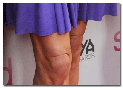 Trong phẫu thuật nâng đầu gối, phần da thừa của đầu gối bị cắt đi rồi khâu lại khiến đầu gối bớt nhăn nheo và cao hơn. Phương pháp phẫu thuật này không gây đau đớn ngoài trừ nhược điểm phải thường xuyên mặc quần để che sẹo.