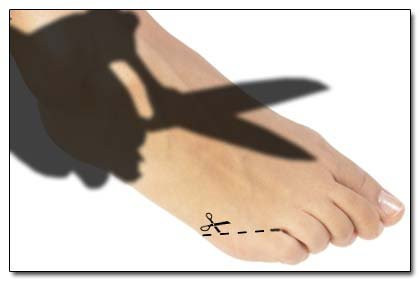 Phẫu thuật ngón chân là một trong những phương pháp phẫu thuật thẩm mỹ kỳ dị nhất dành cho những người không thích hình dạng bàn chân của mình có thể tìm đến phương pháp phẫu thuật chân để giảm bớt mỡ chân, cắt bằng ngón chân hoặc thậm chí là cắt phăng ngón chân út để đi giày cho dễ.