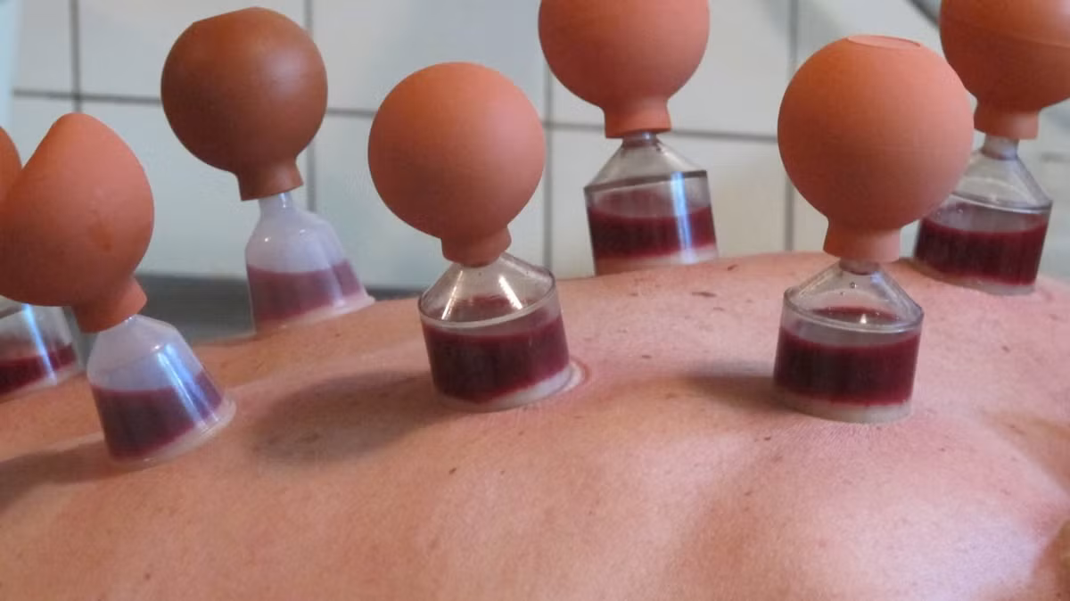 Mặc dù đâu đó vẫn có một vài tan nạn bỏng da đáng tiếc do giác hơi nhưng xem ra đây vẫn là một phương pháp tương đối an toàn. Câu hỏi đặt ra là giác hơi có thật sự hiệu quả?