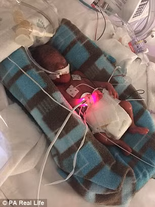 Bác sĩ cho rằng cần phải mổ đẻ ngay nếu không thai nhi sẽ chết trong bụng mẹ. Ngay sau khi chào đời, bé Rayden được đưa ngay tới khoa chăm sóc đặc biệt và được đặt nằm trong lồng ấp. Vì phổi của cậu bé rất yếu và chưa trưởng thành hết nên hệ tiêu hóa phải vật lộn theo rất vất vả. May mắn là khi xét nghiệm không thấy chảy máu não. 