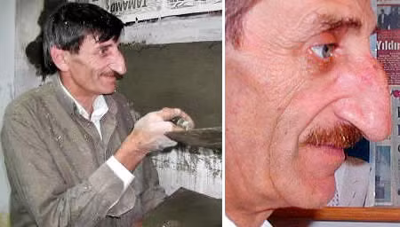 Ông Mehmet Ozyurek sinh ra ở Thổ Nhĩ Kỳ vào năm 1949 là người có chiếc mũi dài nhất thế giới. Khi đo vào năm 2007 thì chiếc mũi của ông dài 8,8cm.