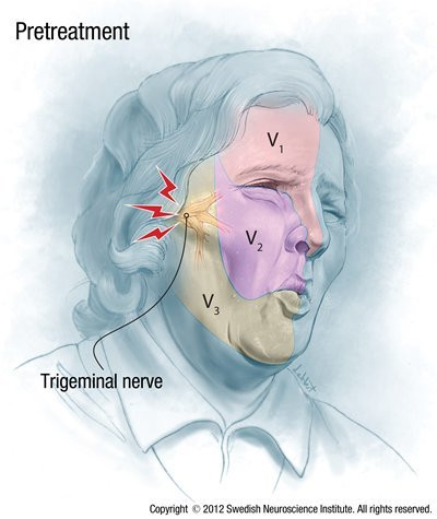 Đau dây thần kinh sinh ba là một dạng viêm dây thần kinh kéo dài từ đầu xuống quai hàm. Cơn đau được mô tả như có ai cầm dao chọc vào. Phương pháp điều trị cũng rất hạn chế và không được gây tê màng cứng, thậm chí có người còn nghĩ rằng thà chết đi còn hơn. 