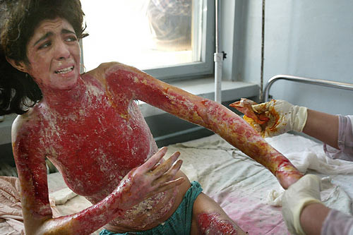 Một chuyên gia về bỏng cho biết khi bị bỏng thì đau không kém gì đau đẻ. Hơn nữa quá trình điều trị sau bỏng cũng rất khổ sở vì phải cắt bỏ mô hoại tử, thay quần áo, ghép da… 