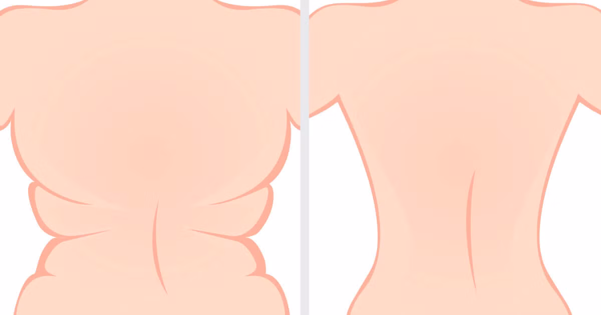 Nếu bạn bị tích mỡ ở lưng và bụng phía dưới ngực nghĩa là bạn ăn quá nhiều đồ ăn vặt và có thói quen bỏ bữa sáng sau đó ăn bù. Nếu kiểm chứng lại, bạn sẽ thấy mình không năng động lắm.