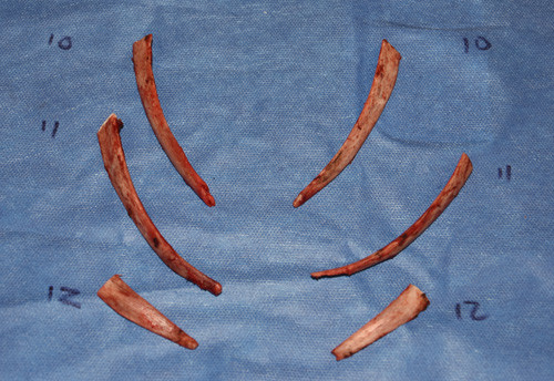 Xương sườn bị tháo để có vòng eo như ý thường là xương sườn số 11 và 12. Đây được coi là những xương an toàn nhất vì nằm ngay dưới chỏm phổi và màng phổi. Tuy nhiên khi tháo hai xương sườn này thường hiệu quả thu nhỏ vòng eo không được bao nhiêu nên một số người còn tháo thêm cả xương số 10. 