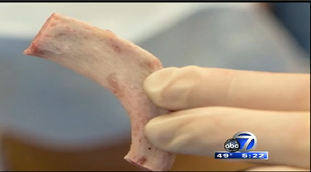 Vì đây là một phương pháp làm đẹp đi ngược lại với tự nhiên nên chắc chắn sẽ có những nguy hiểm. Nguy hiểm phải kể đến đầu tiên là những cơn đau tạm thời hoặc vĩnh viễn, ít nhất cho đến khi vết cắt ở xương lành lại. Ngoài ra còn có nguy cơ tổn thương dây thần kinh gian sườn chạy dọc bên dưới xương sườn bên ngoài ống màng xương. 