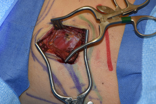 Vết rạch để mổ xương sườn được coi là đẹp khi dài không quá 6cm, song song với xương sườn và nằm ngay trên xương sườn cần tháo. Đường rạch này thường thực hiện ở phía sau để không nhìn thấy từ trực diện. 