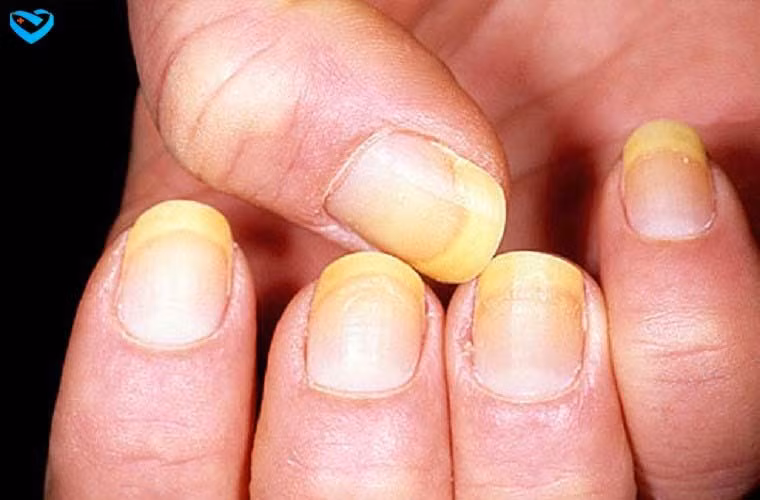 Không nên để đầu móng dài: Đầu móng làm ngón chân trông thập thò không đều nhau và còn nứt nẻ, làm lớp sơn móng bị sứt mẻ nhanh hơn. 