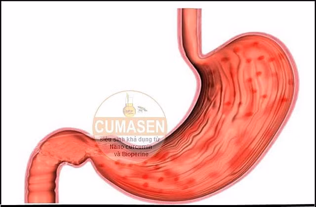 Khi thấy phân chuyển sang màu đen và có mùi rất khó chịu, cô Christine so sánh những dấu hiệu của mình với những dấu hiệu trên một trang web điện tử chuyên về sức khỏe NHS thì thấy có vẻ như mình đã bị chảy máu dạ dày.