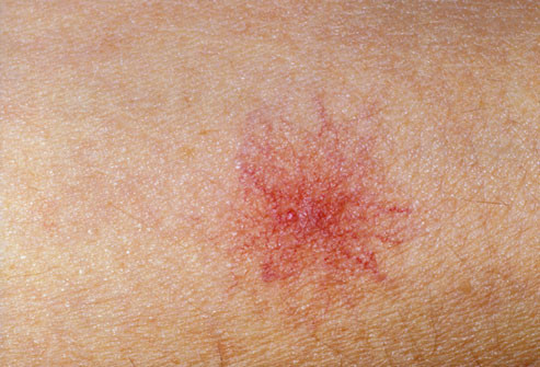 Giãn tĩnh mạch ở ngực và khe ngực khiến khu vực vòng 1 của nữ giới xuất hiện nhiều mạch máu màu xanh hoặc tím khiến phụ nữ mất tự tin. Giãn tĩnh mạch ở ngực có nhiều nguyên nhân nhưng thường gặp ở những người phẫu thuật nâng ngực.