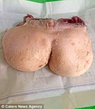 Bào thai song sinh được lấy ra có đủ cả xương, thịt và tóc đã lấy mất một phần máu và dưỡng chất của bé từ khi còn chưa ra đời. Bé Nisha chỉ nặng 8kg trong khi bào thai này đã nặng 3kg. Theo thống kê khoảng 80% trường hợp thai trong thai nằm ở bụng, nhưng cũng có trường hợp thai ký sinh trong sọ. 