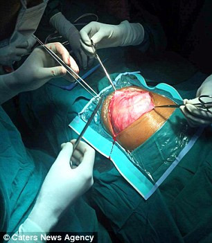 Ngay lập tức bé Nisha được phẫu thuật để lấy khối u này ra và chỉ đến lúc này mới xác định được đó là một bào thai. Ca phẫu thuật kéo dài hơn 2 giờ và khá phức tạp vì thận trái của bé Nisha bị dính vào khối u.