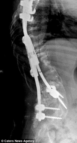 Ellisha hiện mang trong người 2 thanh titan, 8 đinh vít và 4 cái nẹp để cố định xương sống. Cô bé đang chuẩn bị phẫu thuật lần thứ 13 để tiếp tục kéo dài thanh kim loại. 