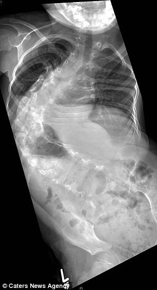 Muốn cho con mình một cơ hội tốt nhất có thể, cặp vợ chồng này đã từ chối không nghe theo lời khuyên của bác sĩ. Khi mới 10 tháng tuổi, bé Ellisha đã được phẫu thuật lần đầu tiên. Những năm đầu đời của cô bé phải sống trong cảnh bó bột nhưng khi lên 6 tuổi, xương sống bị cong gập xấu nhất thành 170 độ, bác sĩ cho biết nếu không phẫu thuật thêm thì xương sống sẽ dần nghiến nát cô bé. 