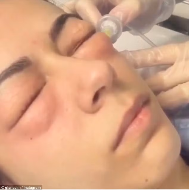 Phương pháp này dựa trên nguyên lý làm tăng oxy ở vùng da bị tối màu để làm giảm quầng thâm và mờ sẹo. Khí CO2 được bơm vào sẽ tự động hấp thu vào cơ thể nên không cần phải hút khí ra. Theo khẳng định của các bệnh viện thực hành, phương pháp này làm tăng sản sinh collagen khiến gương mặt tươi trẻ hơn và hiệu quả kéo dài được 6 tháng.