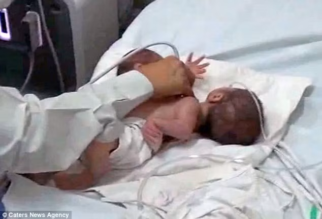 Mẹ của hai bé là Hemlata Singh, 28 tuổi người Ấn Độ, chưa từng đi siêu âm một lần nào trong thai kỳ và dự định sẽ sinh con tại nhà. Tuy nhiên, khi cố gắng đẻ thường nhưng em bé vẫn không chui ra được, bà mẹ này được đưa đến bệnh viện phụ sản Ummed ở Udaipur. 