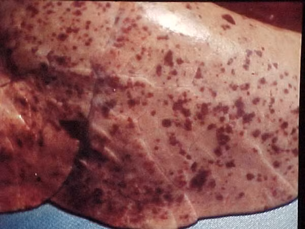 Thương hàn cũng là một bệnh dễ lây lan trong mùa mưa qua thực phẩm và nước đã nhiễm độc với các dấu hiệu như sốt cao, đau đầu, biếng ăn, tiêu chảy hoặc táo bón…Do vậy trong mùa mưa bão cần đun sôi nước uống thêm 2 phút, chế biến kỹ thực phẩm, đậy điệm thức ăn để tránh ruồi và côn trùng khác. 