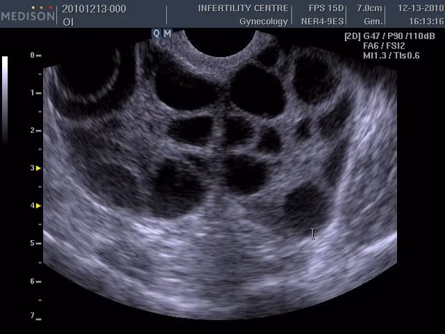 Các nhà nghiên cứu đã từng cảnh báo về nguy cơ nghẽn máu có thể ảnh hưởng tới tính mạng sau khi phụ nữ thụ tinh trong ống nghiệm. Nguy cơ bị đột quỵ ở sản phụ thụ tinh ống nghiệm cao gấp 5 lần sản phụ mang thai tự nhiên. Nguyên nhân là do lượng oestrogen tăng lên quá cao sau khi uống thuốc điều trị vô sinh. Thuốc này cũng khiến phụ nữ bị quá khích buồng trứng. (Nguồn ảnh: Liverpoolecho)