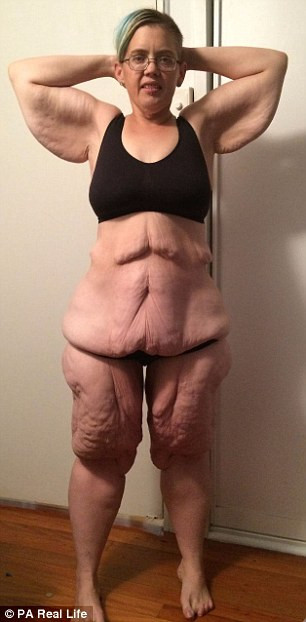 Đối với những người muốn giảm cân thì hẳn sau khi giảm tới 134kg trọng lượng họ sẽ rất tự tin bước ra đường. Nhưng đối với Emma, phần da thừa sau khi giảm cân còn mang lại cho cô nhiều rắc rối hơn và cô không còn tự tin như trước kia. 