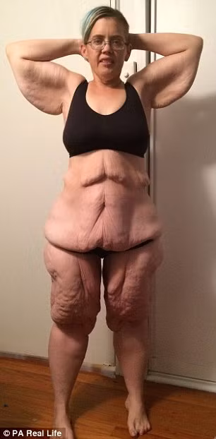 Đối với những người muốn giảm cân thì hẳn sau khi giảm tới 134kg trọng lượng họ sẽ rất tự tin bước ra đường. Nhưng đối với Emma, phần da thừa sau khi giảm cân còn mang lại cho cô nhiều rắc rối hơn và cô không còn tự tin như trước kia. 