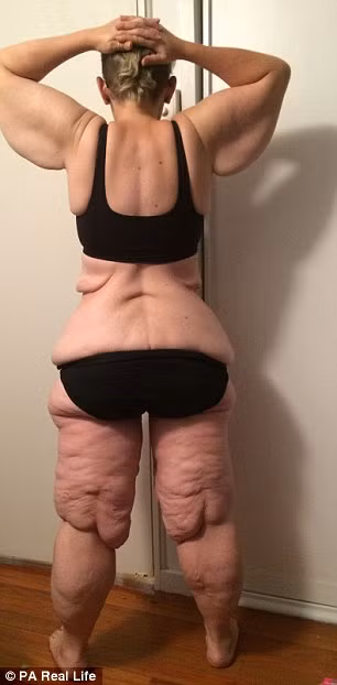 Nguyên nhân là sau khi giảm tới hơn nửa trọng lượng cơ thể, da của cô bị trùng nhão và chảy xệ như bà lão, ước tính chỉ riêng phần da cũng đã nặng tới 38kg. Mặc dù với các số đo hiện tại, cô có thể mặc quần áo size 12 hoặc 14 nhưng vì những cuộn da thừa, cô vẫn phải mặc quần áo size 20. 