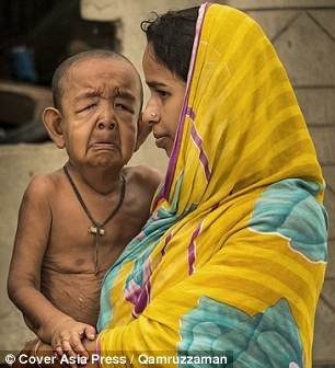 Với tốc độ lão hóa nhanh gấp 8 lần người bình thường, những người mắc bệnh này thường sẽ bị đau tim hoặc đột quỵ và sống không quá 13 năm. Ngoài ra, bé Bayezid còn bị sa dãn da, một rối loạn liên kết tế bào khiến da chảy xệ, nhăn nheo và đầy nếp gấp. 