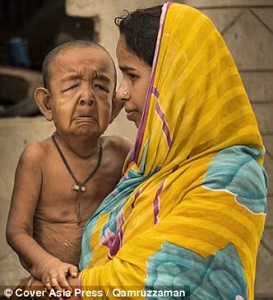 Với tốc độ lão hóa nhanh gấp 8 lần người bình thường, những người mắc bệnh này thường sẽ bị đau tim hoặc đột quỵ và sống không quá 13 năm. Ngoài ra, bé Bayezid còn bị sa dãn da, một rối loạn liên kết tế bào khiến da chảy xệ, nhăn nheo và đầy nếp gấp. 