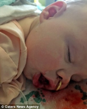 Hai tháng sau, bé Rory được phẫu thuật cắt đi một phần chiếc lưỡi quá khổ. Các bác sĩ đã cắt đầu lưỡi của bé thành hình chữ W rồi khâu lại. Lưỡi của bé vẫn sưng nhưng đã nằm gọn trong miệng. Rory hiện đã 14 tuổi đã hồi phục sau ca phẫu thuật và đã biết gọi mẹ. 